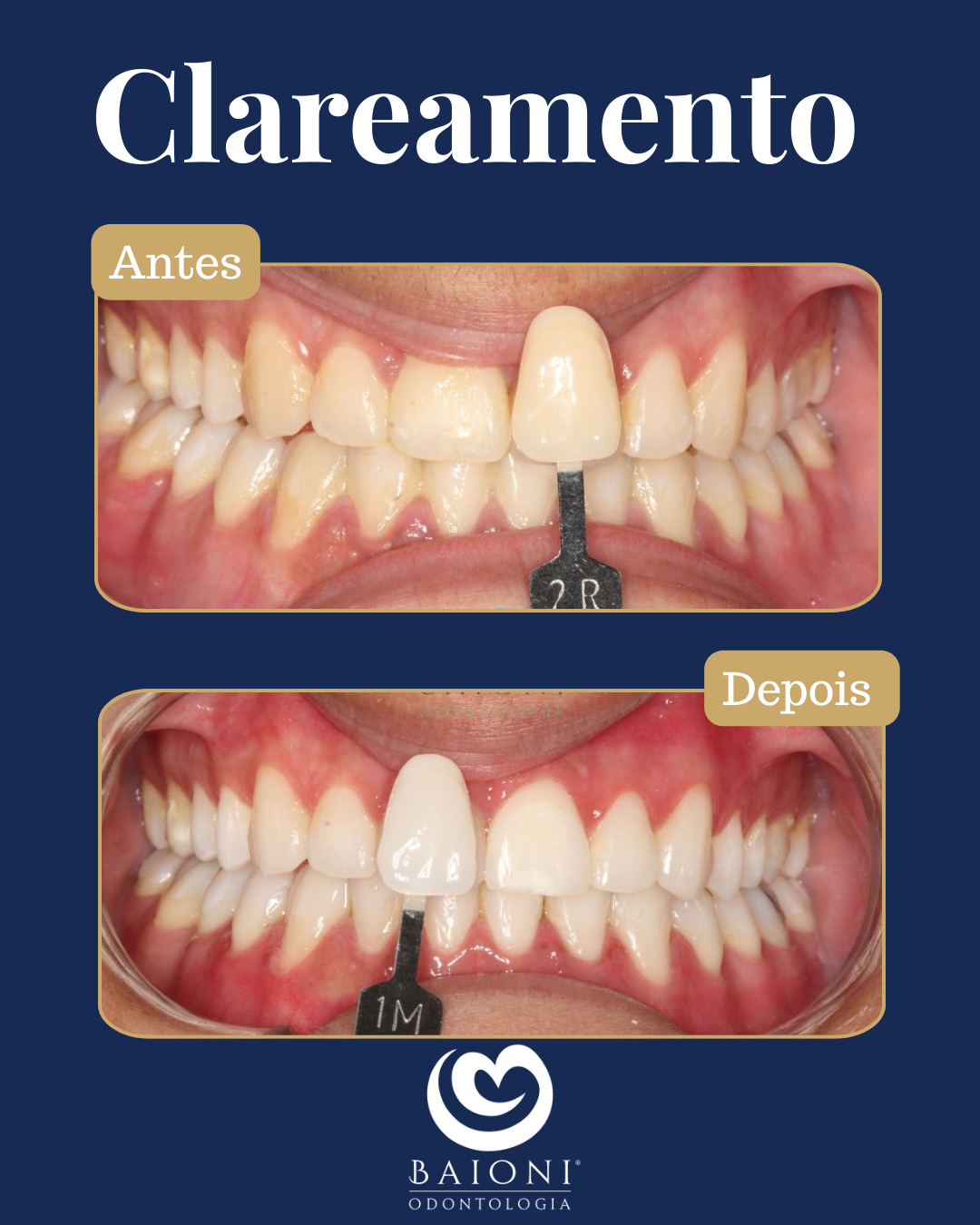 antes e depois